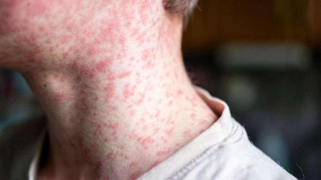 Según los CDC, aproximadamente 1 de cada 5 personas no vacunadas en Estados Unidos que contraigan sarampión serán hospitalizadas. Natalya Maisheva/iStockphoto/Getty Images
