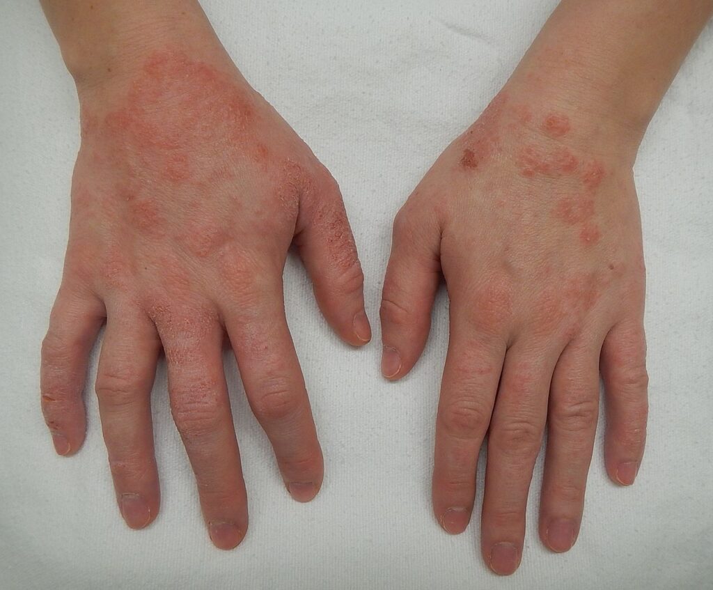 Imagen: James Heilman, MD